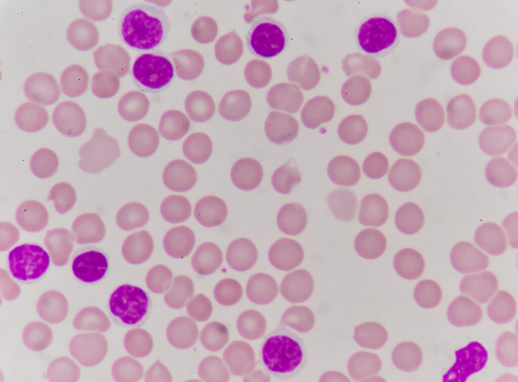 Blood smear descriptive of chronic leukemia where there is an increased number of mature leukocytes.