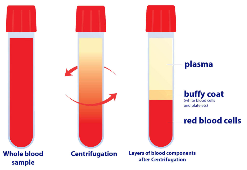 Layers of Blood Components after Centrifugation from bottom to top: Red blood cells, buffy coat layer comprised of the white blood cells and platelets, and the plasma layer.