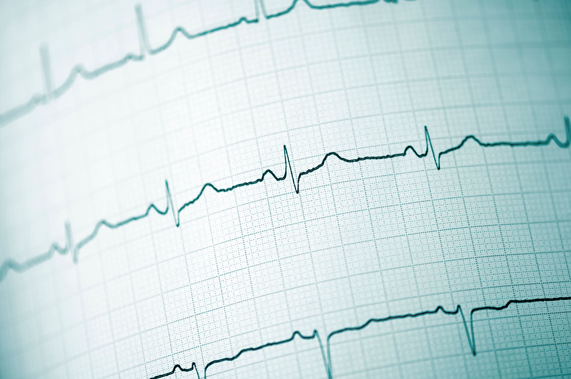 How to Do an ECG at Home | Wellue 24 Hour ECG Recorder | Interactive ...